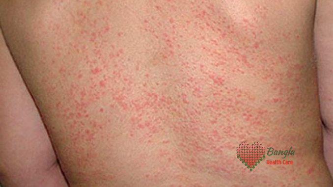 ঘাম ও ঘামাচি থেকে চর্মরোগ ও তার প্রতিকার