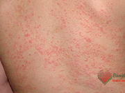 ঘাম ও ঘামাচি থেকে চর্মরোগ ও তার প্রতিকার ঘাম ও ঘামাচি থেকে চর্মরোগ ও তার প্রতিকার