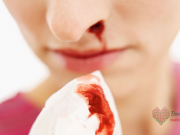 নাক দিয়ে রক্ত পরা ও এর প্রতিকার নাক দিয়ে রক্ত পরা ও এর প্রতিকার