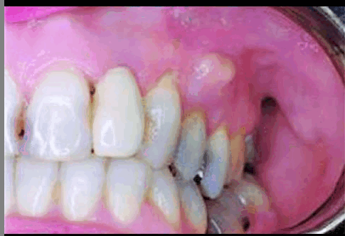 মাড়ির রক্ত পড়া বন্ধ করুন ঘরোয়া ৪ উপায়ে