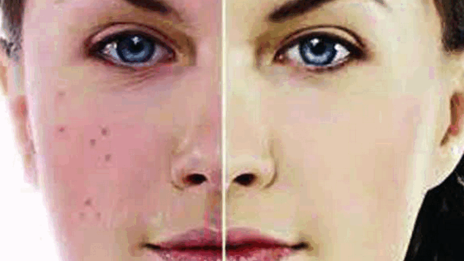 অ্যাসপিরিন ওষুধ ব্যবহারে ভালো হবে ব্রণ!