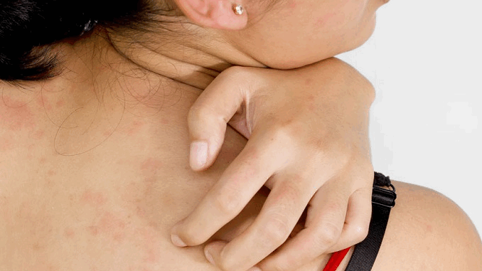 গরমে ঘামাচি সারানোর ঘরোয়া ৭ উপায়