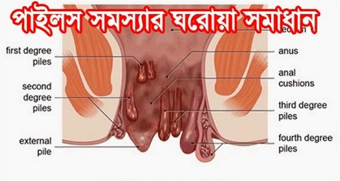 পাইলস রোগ এবং এর চিকিৎসা