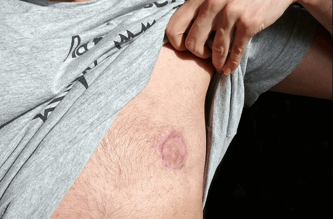 পুরুষদের স্তন ক্যান্সারের প্রবণতা বাড়ছে