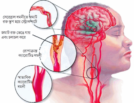 স্ট্রোক হতে পারে ছোটদের ও – সাবধান হন