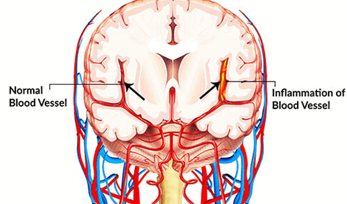 Cerebral Vasculitis – সেরিব্রাল ভাস্কুলাইটিস – মস্তিষ্কের রক্তনালীর প্রদাহ রোগ