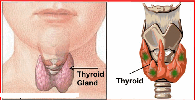 থাইরয়েড এর সমস্যা হলে কি করবেন – Thyroid Problem Treatment
