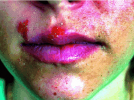 মুখ ও ঠোঁটে ভাইরাস সংক্রমণ