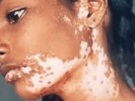 শ্বেতী রোগ – এটা কোন ছোয়াচে রোগ নয়, কোন অভিশাপও নয়