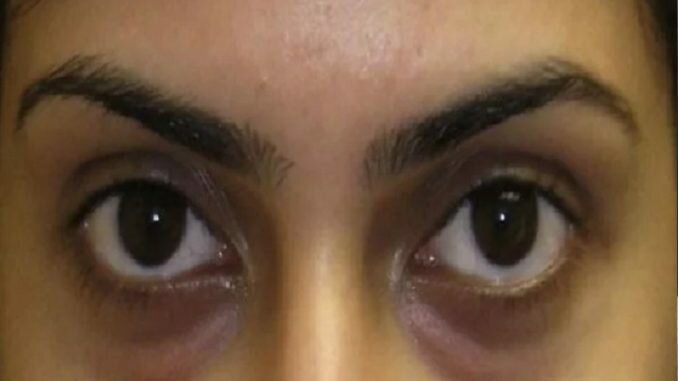 চোখের নিচের ফোলাভাব ও কালচে দাগ কমাবে গোলাপের পাপড়ি, দেখুন বিস্তারিত